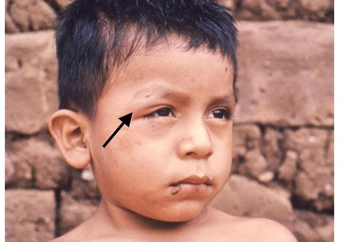 Dr. T. Alvarez General Hospital Pathogens | Free Full-Text | Chagas Cardiomyopathy: From Romaña ... photo